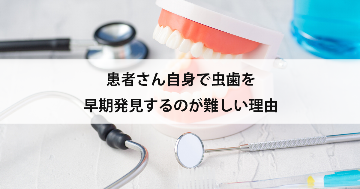 【新潟市中央区新潟駅の歯医者で虫歯治療】患者さん自身で虫歯を早期発見するのが難しい理由