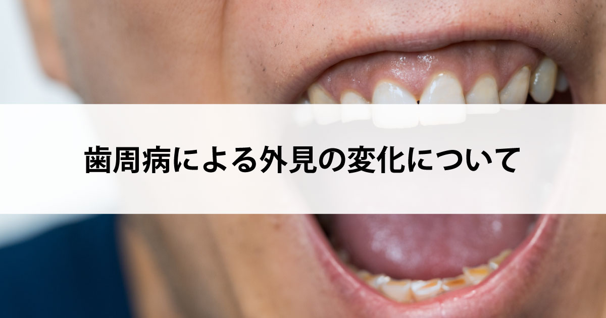 【新潟市中央区新潟駅の歯医者で歯周病治療】歯周病による外見の変化について