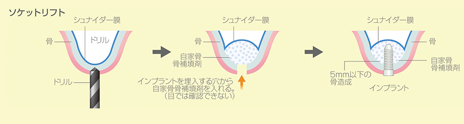 ソケットリフト法