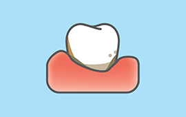 歯周病の悪化