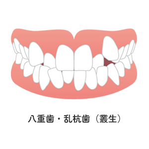 八重歯・乱杭歯（叢生）