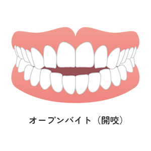 オープンバイト（開咬）