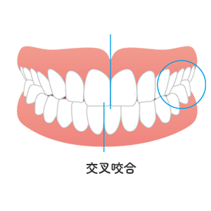 交叉咬合