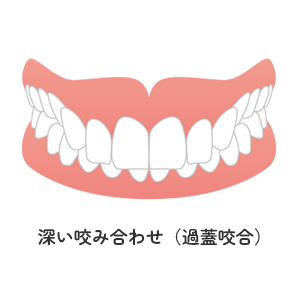 深い咬み合わせ（過蓋咬合）