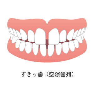 すきっ歯（空隙歯列）