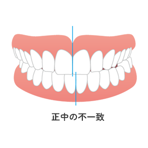 正中の不一致