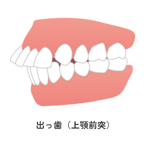 出っ歯（上顎前突）