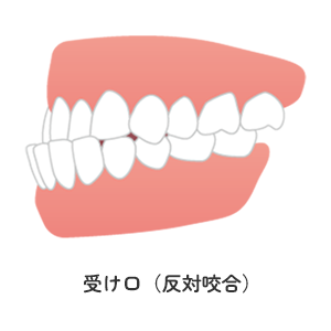 受け口（反対咬合）