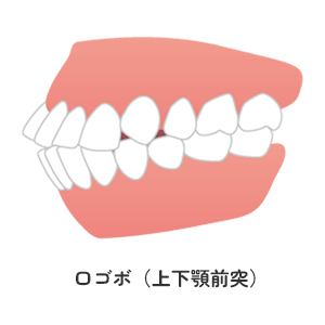 口ゴボ（上下顎前突）